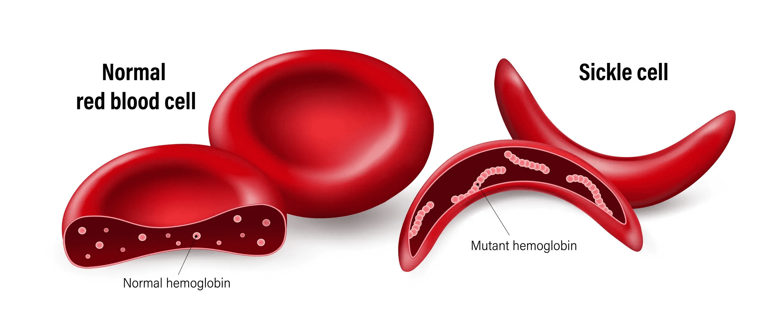 Sickle Cell versus Normal Blood Cell